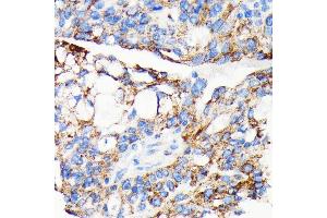 Immunohistochemistry of paraffin-embedded human oophoroma using AIF antibody (ABIN7265648) at dilution of 1:100 (40x lens). (AIF 抗体)