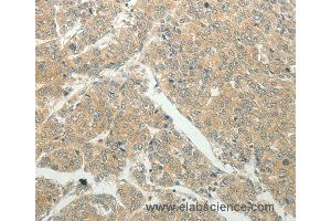 Immunohistochemistry of Human liver cancer using SLC8A3 Polyclonal Antibody at dilution of 1:50 (SLC8A3 抗体)