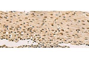 Immunohistochemistry of paraffin-embedded Human cervical cancer tissue using LRIF1 Polyclonal Antibody at dilution of 1:70(x200) (C1orf103 抗体)