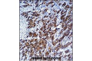 LGALS3 Antibody (C-term) (ABIN1536595 and ABIN2843799) immunohistochemistry analysis in formalin fixed and paraffin embedded human breast carcinoma followed by peroxidase conjμgation of the secondary antibody and DAB staining. (Galectin 3 抗体  (C-Term))