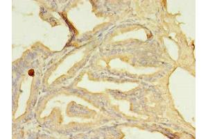 Immunohistochemistry of paraffin-embedded human prostate cancer using ABIN7169587 at dilution of 1:100