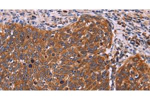 Immunohistochemistry of paraffin-embedded Human cervical cancer tissue using FBXW7 Polyclonal Antibody at dilution 1:40 (FBXW7 抗体)