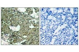 Immunohistochemical analysis of paraffin-embedded human breast carcinoma tissue using MEK1(Phospho-Ser221) Antibody(left) or the same antibody preincubated with blocking peptide(right). (MEK1 抗体  (pSer221))