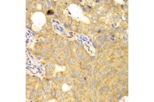 Immunohistochemistry of paraffin-embedded human oophoroma using GNB2L1 antibody at dilution of 1:100 (400x lens). (GNB2L1 抗体)