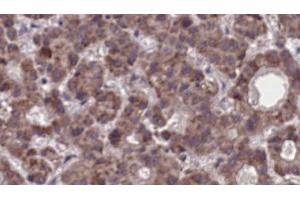 ABIN6273904 at 1/100 staining Human liver cancer tissue by IHC-P. (LPAR5 抗体  (Internal Region))