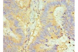 Immunohistochemistry of paraffin-embedded human colon cancer using ABIN7154050 at dilution of 1:100 (Glutaredoxin 2 抗体  (AA 1-124))