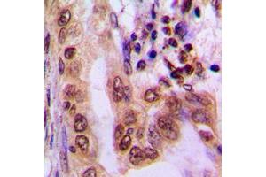 Immunohistochemical analysis of AMPK alpha 1/2 (pT183/172) staining in human lung cancer formalin fixed paraffin embedded tissue section. (PRKAA1/PRKAA2 抗体  (pSer172, pSer183))