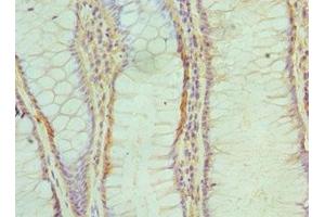 Immunohistochemistry of paraffin-embedded human colon cancer using ABIN7143717 at dilution of 1:100 (ALKBH1 抗体  (AA 110-389))