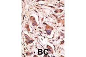 Formalin-fixed and paraffin-embedded human cancer tissue reacted with the primary antibody, which was peroxidase-conjugated to the secondary antibody, followed by DAB staining. (MAGED1 抗体  (AA 426-456))
