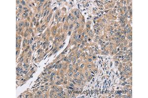 Immunohistochemistry of Human lung cancer using PPP1CC Polyclonal Antibody at dilution of 1:40 (PPP1CC 抗体)