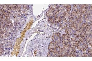 ABIN6273258 at 1/100 staining Human pancreas cancer tissue by IHC-P. (KCTD12 抗体  (Internal Region))