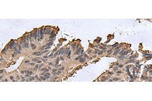 Immunohistochemistry of paraffin-embedded Human colorectal cancer tissue using DCTPP1 Polyclonal Antibody at dilution of 1:85(x200) (DCTPP1 抗体)