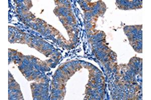 The image on the left is immunohistochemistry of paraffin-embedded Human cervical cancer tissue using ABIN7193124(Gjc3 Antibody) at dilution 1/10, on the right is treated with synthetic peptide. (GJC3 抗体)