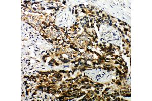 Anti-Hamartin antibody, IHC(P) IHC(P): Human Mammary Cancer Tissue (TSC1 抗体  (C-Term))
