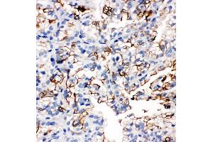 Anti-Aquaporin 1 antibody, IHC(P) IHC(P): Human Kidney Cancer Tissue (Aquaporin 1 抗体  (C-Term))