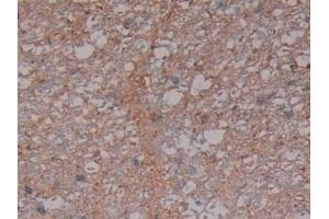 Immunohistochemistry (IHC) image for anti-Synuclein, gamma (Breast Cancer-Specific Protein 1) (SNCG) (AA 1-123) antibody (ABIN7429346)