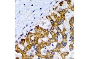 Immunohistochemical analysis of SCP2 staining in human liver cancer formalin fixed paraffin embedded tissue section. (SCP2 抗体)