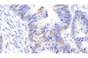 Detection of NPM1 in Human Colorectal cancer Tissue using Polyclonal Antibody to Nucleophosmin 1 (NPM1) (NPM1 抗体  (AA 20-154))