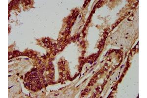 IHC image of ABIN7166221 diluted at 1:200 and staining in paraffin-embedded human prostate cancer performed on a Leica BondTM system. (IGSF9 抗体  (AA 132-298))