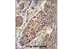 CYC1 Antibody immunohistochemistry analysis in formalin fixed and paraffin embedded human lung carcinoma followed by peroxidase conjugation of the secondary antibody and DAB staining. (Cytochrome C1 抗体  (C-Term))