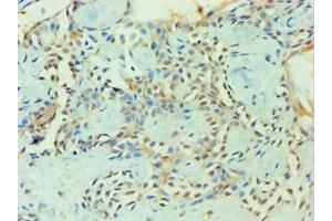 Immunohistochemistry of paraffin-embedded human breast cancer using ABIN7176252 at dilution of 1:100 (ZNF346 抗体  (AA 1-294))