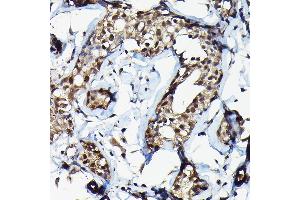 Immunohistochemistry of paraffin-embedded human breast cancer using SUFU Rabbit pAb (ABIN6133029, ABIN6148692, ABIN6148694 and ABIN6217424) at dilution of 1:100 (40x lens). (SUFUH 抗体  (AA 325-484))