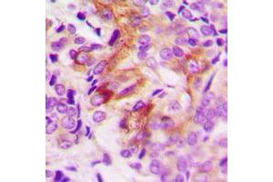 Immunohistochemical analysis of ANGPTL7 staining in human breast cancer formalin fixed paraffin embedded tissue section. (ANGPTL7 抗体  (C-Term))