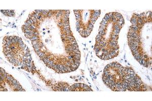 Immunohistochemistry of paraffin-embedded Human colon cancer tissue using HCRTR1 Polyclonal Antibody at dilution 1:70