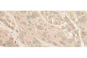 Immunohistochemistry of paraffin-embedded Human esophagus cancer tissue using PSMC4 Polyclonal Antibody at dilution of 1:25(x200) (PSMC4 抗体)