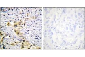 Immunohistochemistry analysis of paraffin-embedded human lung carcinoma tissue, using IGF2R (Ab-2484) Antibody. (IGF2R 抗体  (AA 2441-2490))