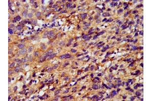IHC image of ABIN7159577 diluted at 1:400 and staining in paraffin-embedded human ovarian cancer performed on a Leica BondTM system. (METAP1 抗体  (AA 54-125))