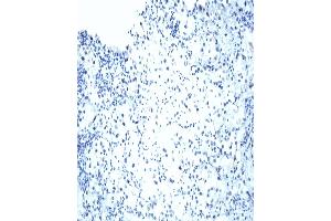VHL Immunohistochemical staining on human renal cell carcinoma. (VHL 抗体  (AA 1-213))