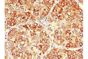 Immunohistochemistry of paraffin-embedded human liver cancer using ABIN7150701 at dilution of 1:100 (MEK2 抗体  (AA 264-400))
