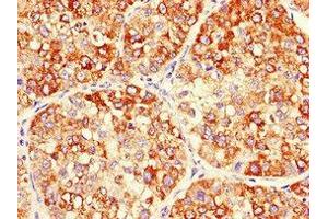 Immunohistochemistry of paraffin-embedded human liver cancer using ABIN7150701 at dilution of 1:100