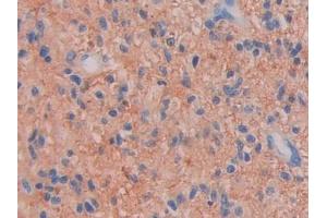DAB staining on IHC-P; Samples: Human Glioma Tissue (Factor VII 抗体  (AA 334-452))