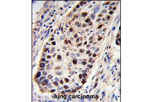 PCNA Antibody (C-term) (ABIN389344 and ABIN2839453) immunohistochemistry analysis in formalin fixed and paraffin embedded human lung carcinoma followed by peroxidase conjugation of the secondary antibody and DAB staining. (PCNA 抗体  (C-Term))