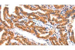 Immunohistochemistry of paraffin-embedded Human thyroid cancer tissue using AK5 Polyclonal Antibody at dilution 1:60 (Adenylate Kinase 5 抗体)