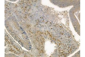 ABIN6260996 and ABIN6272569 at 1/100 staining human colon carcinoma by IHC-P. (COX7B 抗体  (Internal Region))