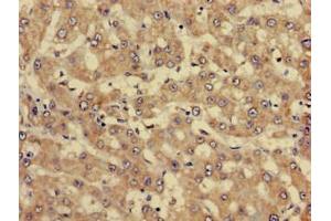 Immunohistochemistry of paraffin-embedded human liver cancer using ABIN7144337 at dilution of 1:100 (SERPINC1 抗体  (AA 37-180))