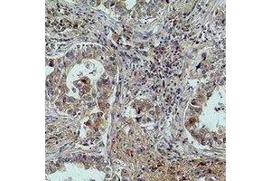 Immunohistochemical analysis of MICU1 staining in human lung cancer formalin fixed paraffin embedded tissue section. (MICU1 抗体)
