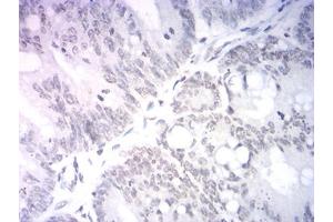 Immunohistochemical analysis of paraffin-embedded rectum cancer tissues using Neurod mouse mAb with DAB staining. (NEUROD1 抗体  (AA 26-91))