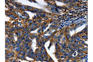 The image on the left is immunohistochemistry of paraffin-embedded Human ovarian cancer tissue using ABIN7189591(ABCC5 Antibody) at dilution 1/50, on the right is treated with synthetic peptide. (ABCC5 抗体)
