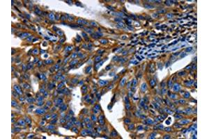 The image on the left is immunohistochemistry of paraffin-embedded Human ovarian cancer tissue using ABIN7189591(ABCC5 Antibody) at dilution 1/50, on the right is treated with synthetic peptide.