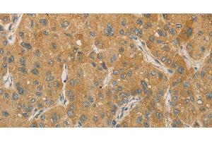Immunohistochemistry of paraffin-embedded Human liver cancer tissue using PRPSAP1 Polyclonal Antibody at dilution 1:80 (PRPSAP1 抗体)