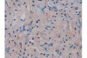 IHC-P analysis of Human Lung cancer Tissue, with DAB staining. (IL17RA 抗体  (AA 377-534))