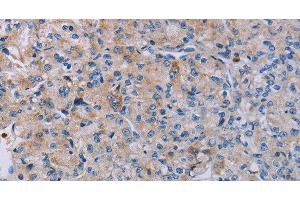 Immunohistochemistry of paraffin-embedded Human prostate cancer using P2RY2 Polyclonal Antibody at dilution of 1:40
