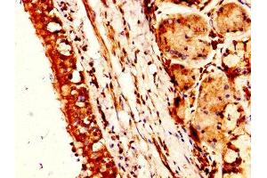IHC image of ABIN7161457 diluted at 1:300 and staining in paraffin-embedded human lung cancer performed on a Leica BondTM system. (Neurotensin 抗体  (AA 24-143))
