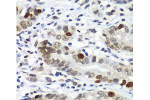Immunohistochemistry of paraffin-embedded Human gastric cancer using DR1 Polyclonal Antibody at dilution of 1:100 (40x lens). (DR1 抗体)