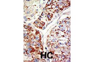Formalin-fixed and paraffin-embedded human hepatocellular carcinoma tissue reacted with EZH1 polyclonal antibody  , which was peroxidase-conjugated to the secondary antibody, followed by DAB staining . (EZH1 抗体  (Internal Region))
