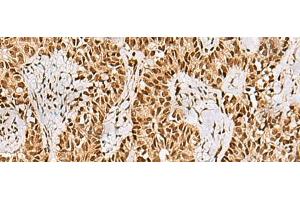 Immunohistochemistry of paraffin-embedded Human ovarian cancer tissue using PHF5A Polyclonal Antibody at dilution of 1:55(x200) (PHF5A 抗体)